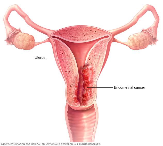 Microbios vaginales indican cáncer de endometrio