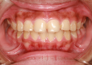 Cáncer bucal, una de las diez neoplasias más frecuentes en el ser humano