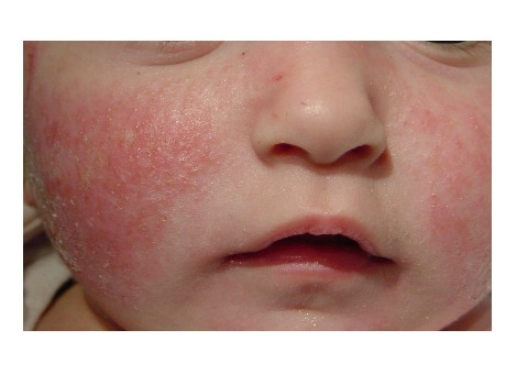Dermatitis Atópica se presenta en los primeros cinco años de vida