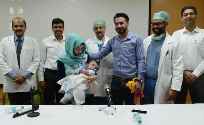 Operan con éxito a bebé con 4 brazos y 4 piernas en India