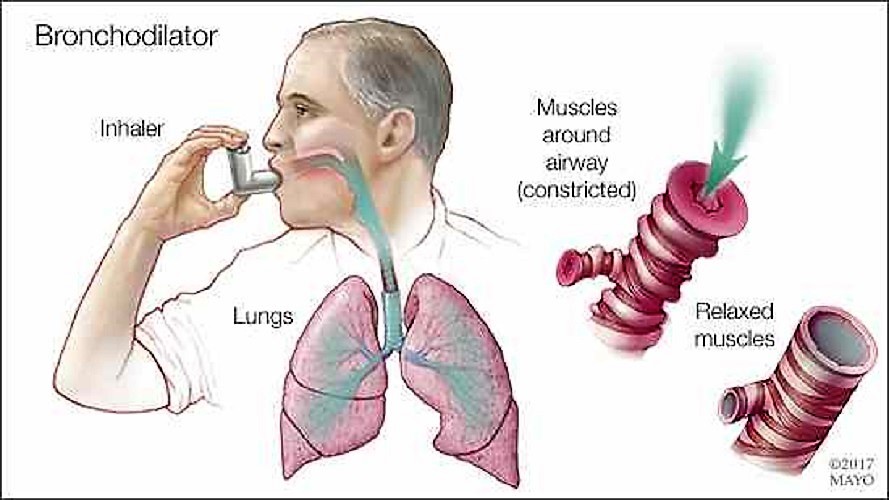 Lo que debes saber de EPOC y broncodilatadores