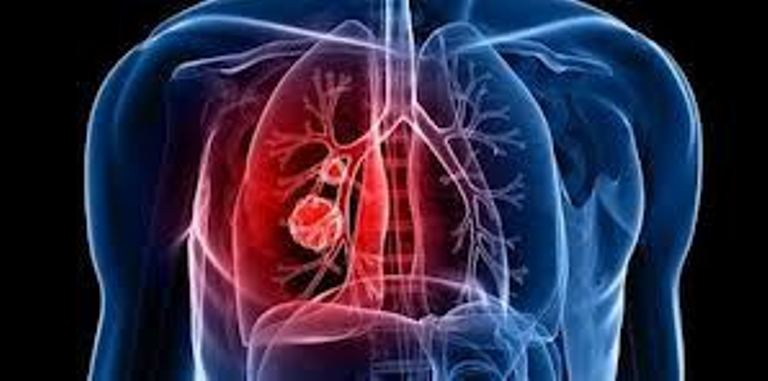 OTRAS INQUISICIONES: Hipertensión Pulmonar: Enfermedad  invisible