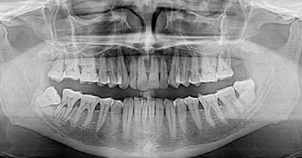 Adiós implantes dentales: ¡Haz crecer tus dientes en tan solo 9 semanas!