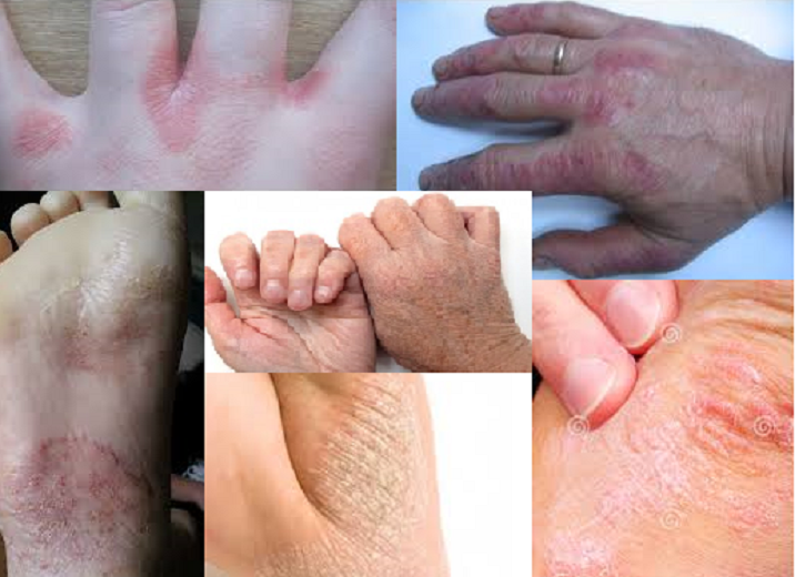Psoriasis y dermatitis atópica, aparecen y se agravan con el frío