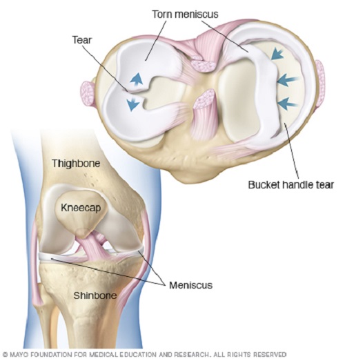 Rotura De Menisco Una De Las Lesiones De Rodilla Más Frecuentes Mayo Clinic Almomento