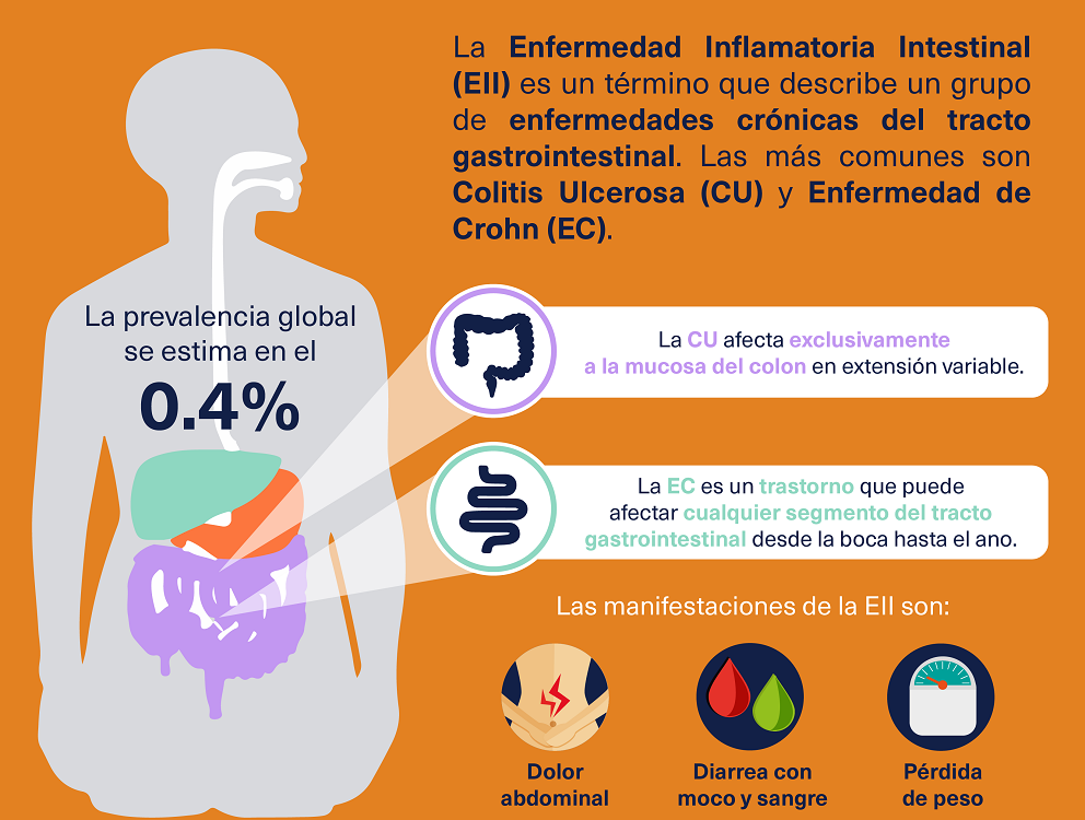 Enfermedad Inflamatoria Intestinal afecta más a la población del norte del país