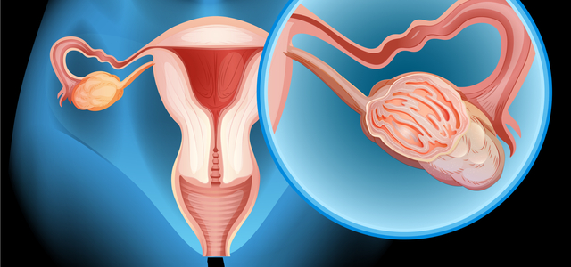 Cáncer de ovario puede ser curable en 90% de los casos detectados en etapa inicial: InCan