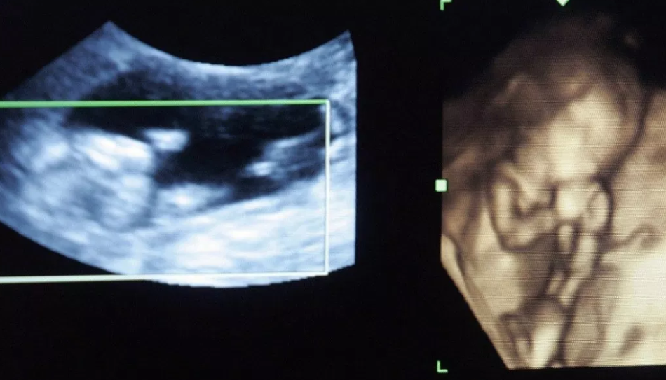VIDEO: Bebé colombiana nace embarazada