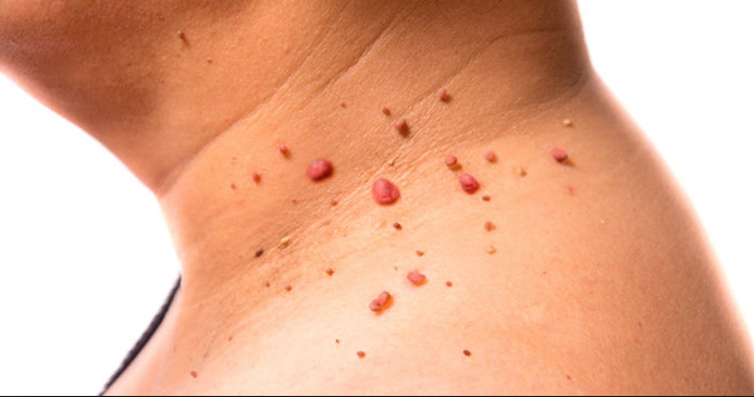 Las Verrugas en la piel brotan por una infección causada por el Virus del Papiloma Humano