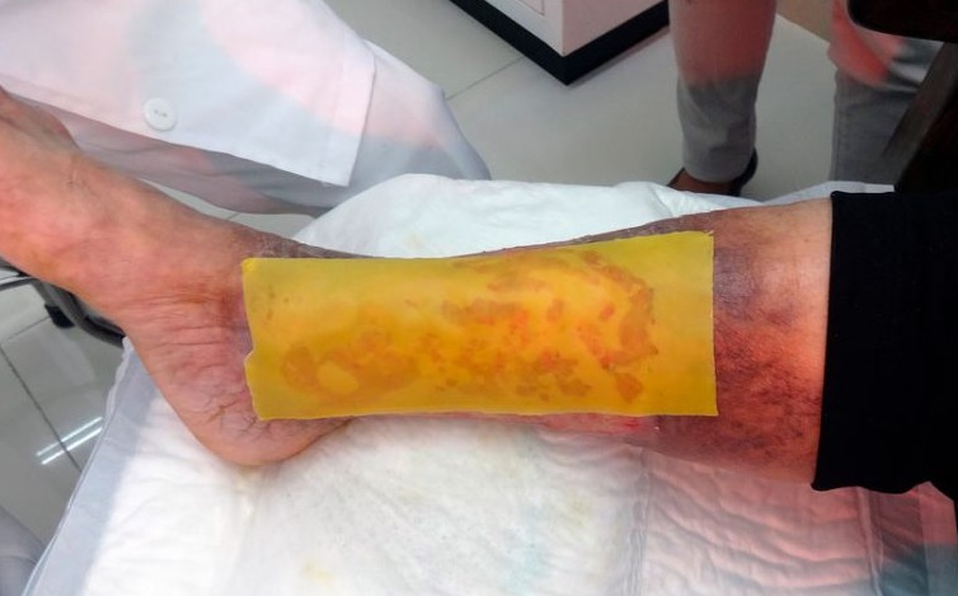 Científicos de la UNAM desarrollan parche que regenera piel de diabéticos