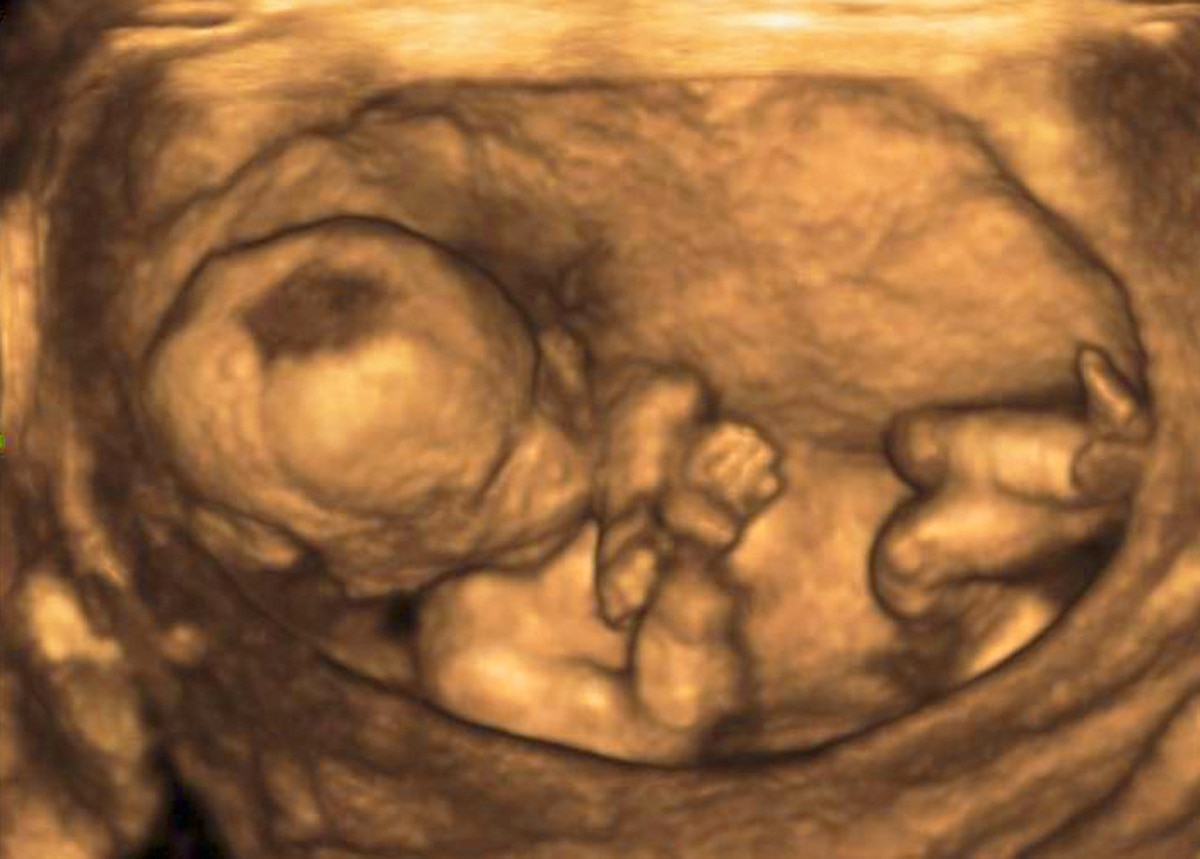 En Eslovaquia, una ley pretende obligar a mujeres a ver su feto antes de abortar