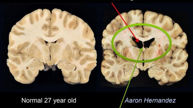 Así cambia el cerebro después de una infección por Covid