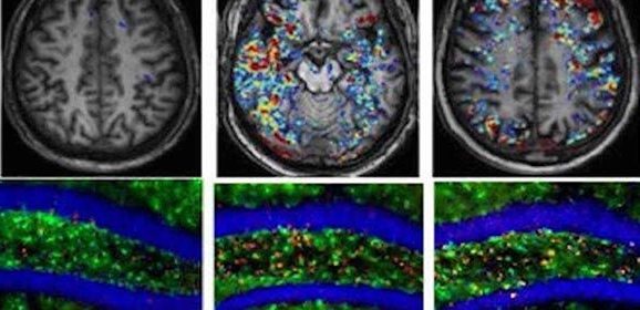 El COVID-19 causa daños en el cerebro similares a los del Alzheimer y el Parkinson