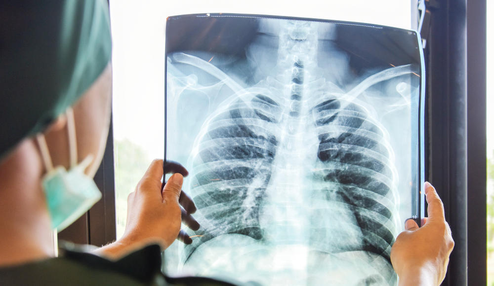 60% de los casos de cáncer de pulmón son detectados en etapas avanzadas