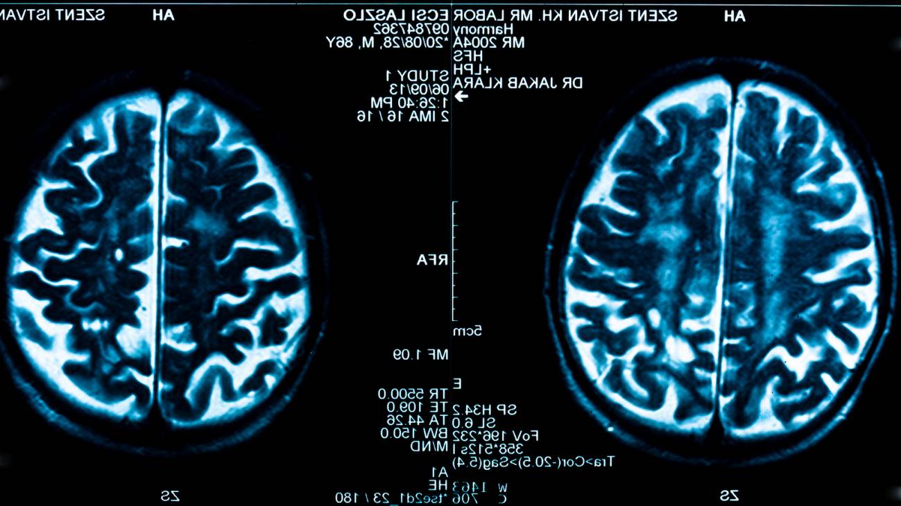 Enfermos de COVID-19 pueden sufrir daños en vasos del cerebro: INH
