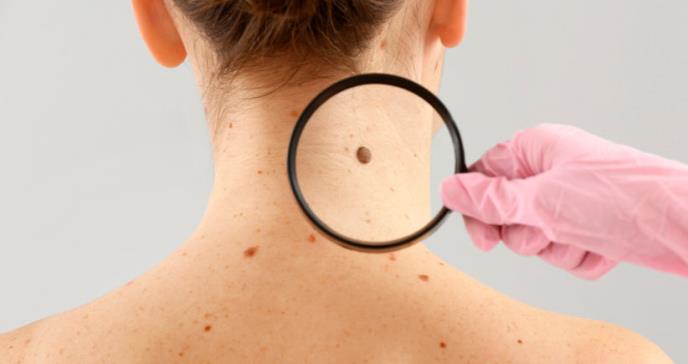 Melanoma, detecta la enfermedad a tiempo.