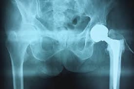 Cada tres segundos se registra en el mundo una fractura de cadera o de alguna extremidad asociada a osteoporosis