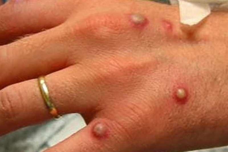 Confirma Secretaría de Salud 91 casos de viruela símica en el país