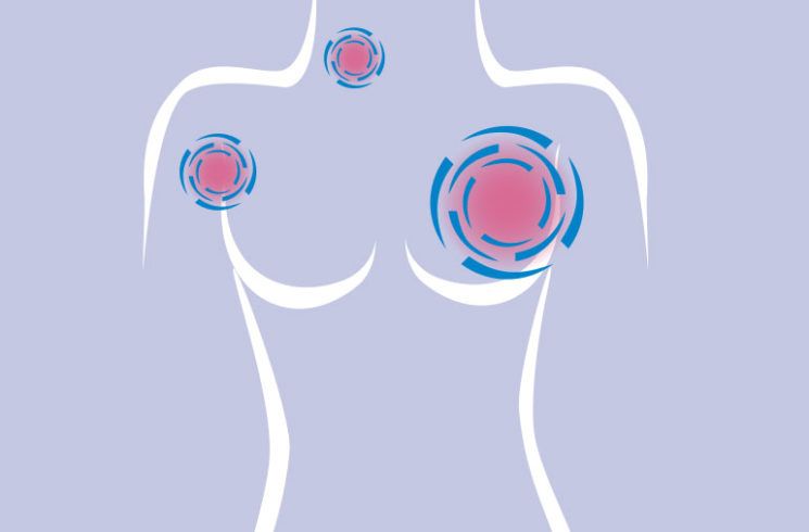La Inteligencia Artificial podría ayudar detectar el cáncer de mama, según científicos