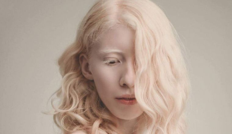 Albinismo, condición detectable con pruebas genéticas