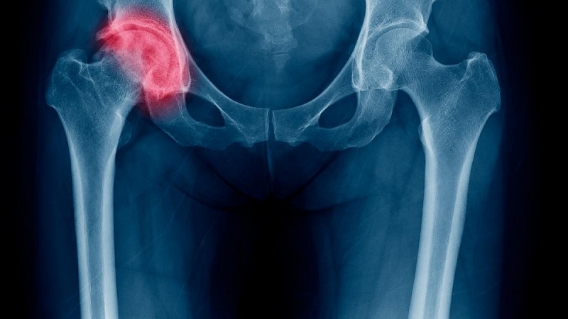 Fracturas de cadera por osteoporosis superarán los 110,000 casos para el año 2050