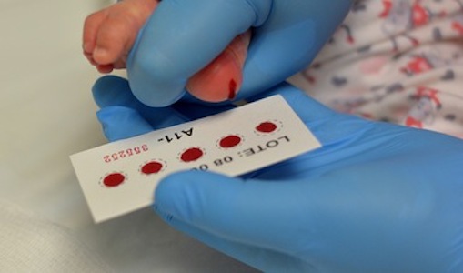 Fibrosis quística, enfermedad detectable con la prueba de tamiz neonatal