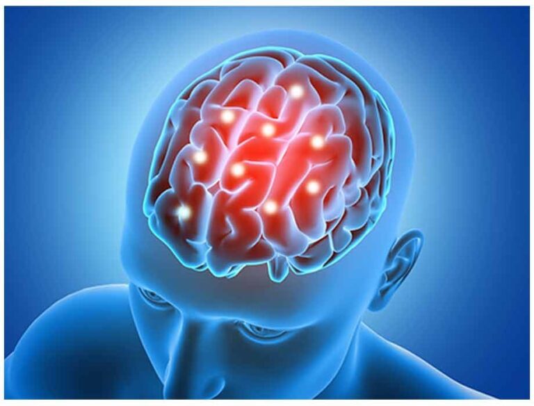 Médicos alertan sobre aumento de infartos cerebrales en México; urge capacitación